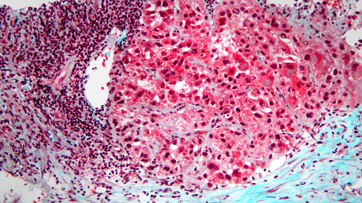 Photo: cns.utexas.edu L’Université du Texas crée un Médicament qui Stresse le Métabolisme du Cancer