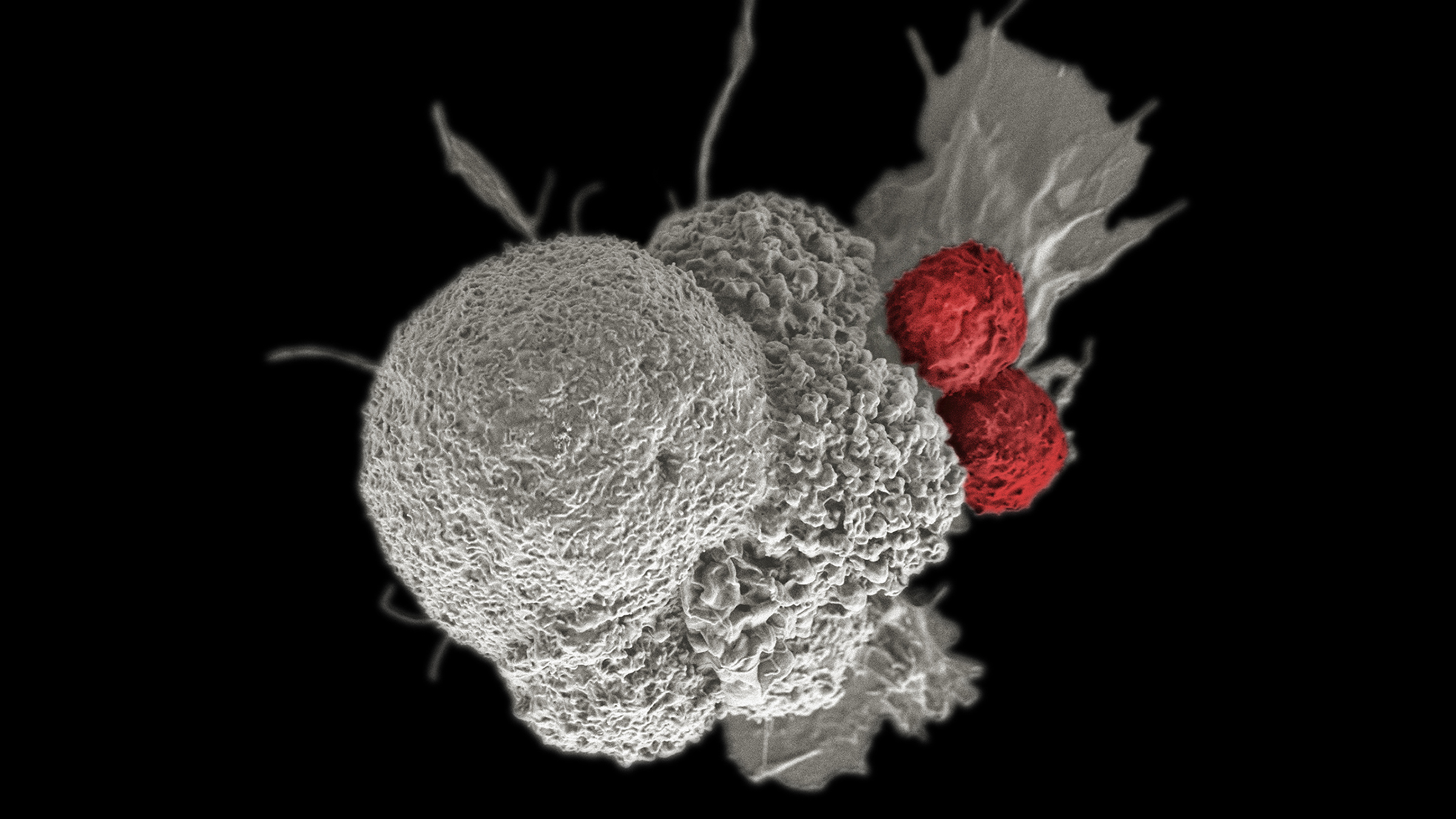 Microscope image of a cancer cell with immune cells attached