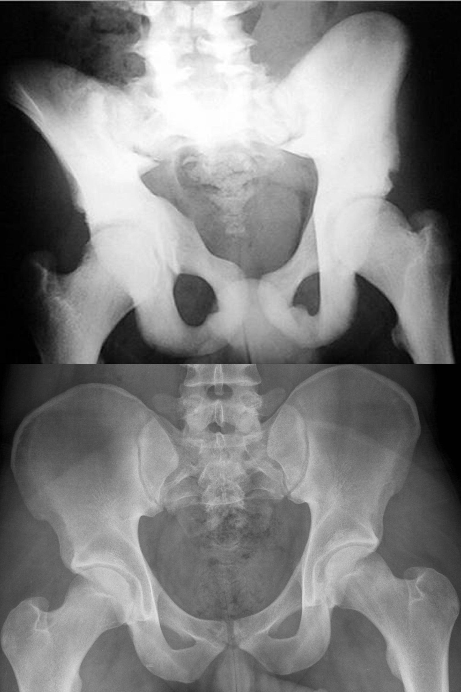 Two x-ray images, each of a human pelvis. One shows thicker bones, the other thinner.