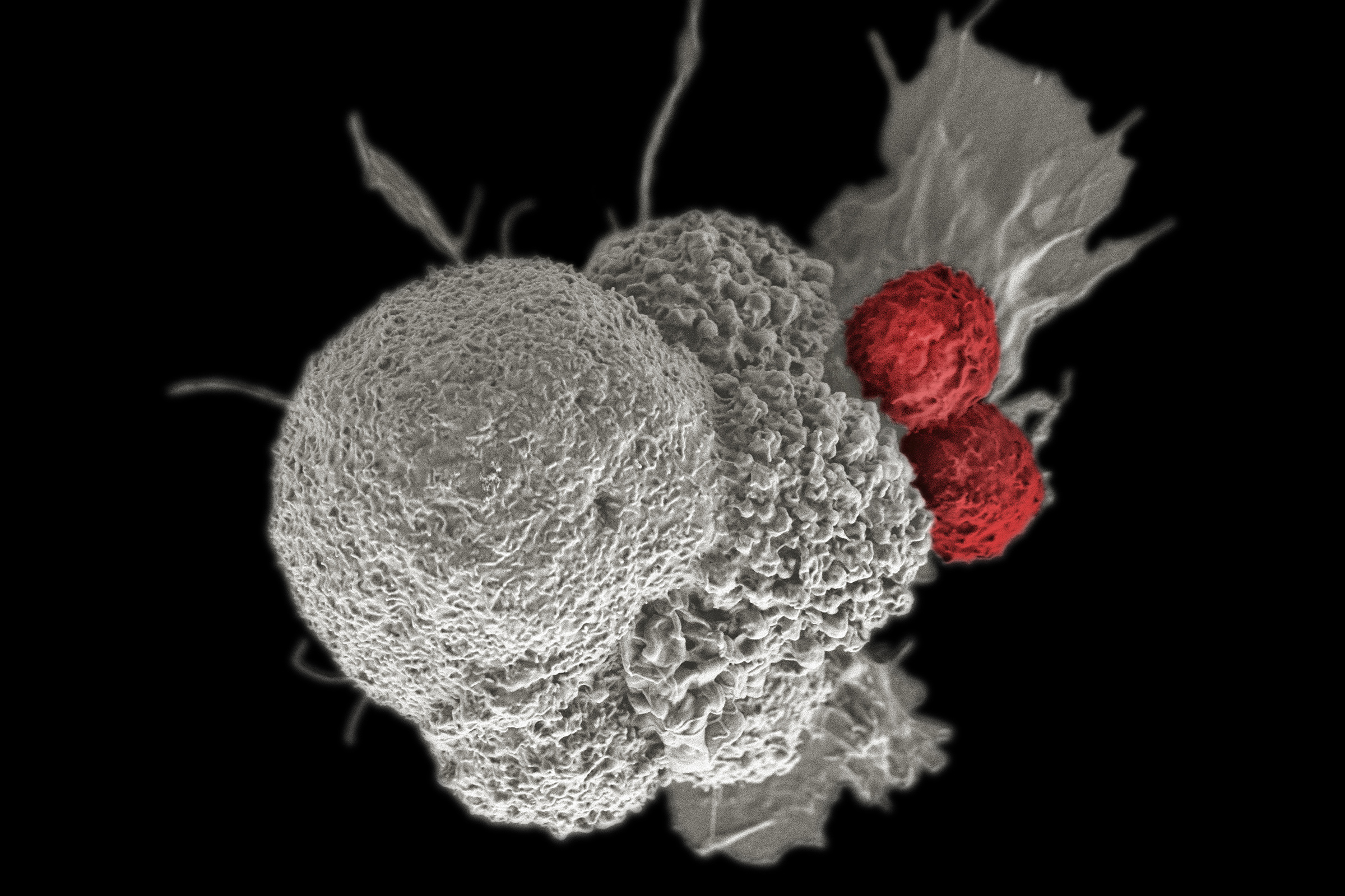 Microscope image of cancer cell with immune cells attached