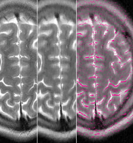 In a traditional MRI image (left), each pixel represents a type of tissue.
