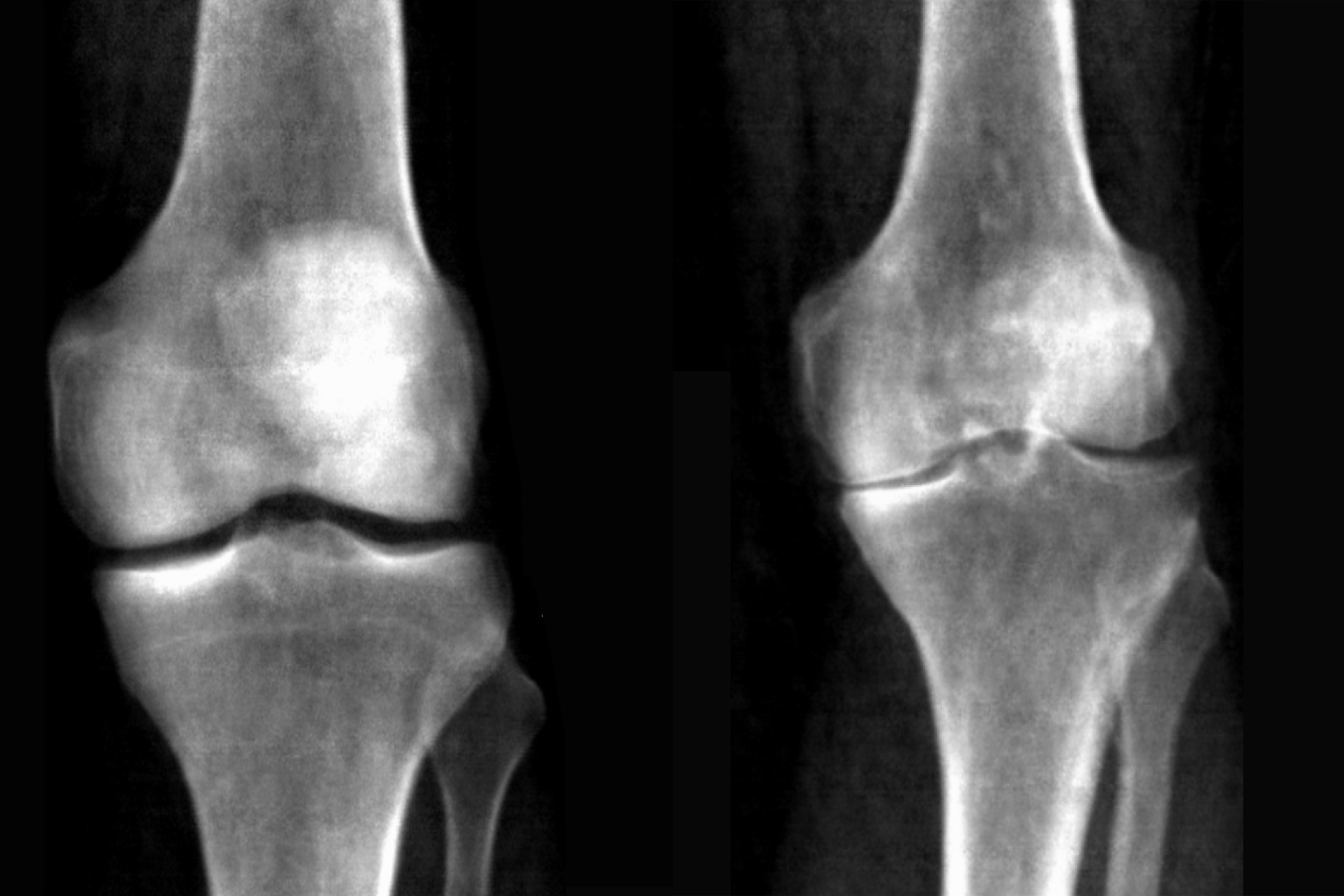 AI Tech Accurately Diagnoses Knee Arthritis from Medical Images