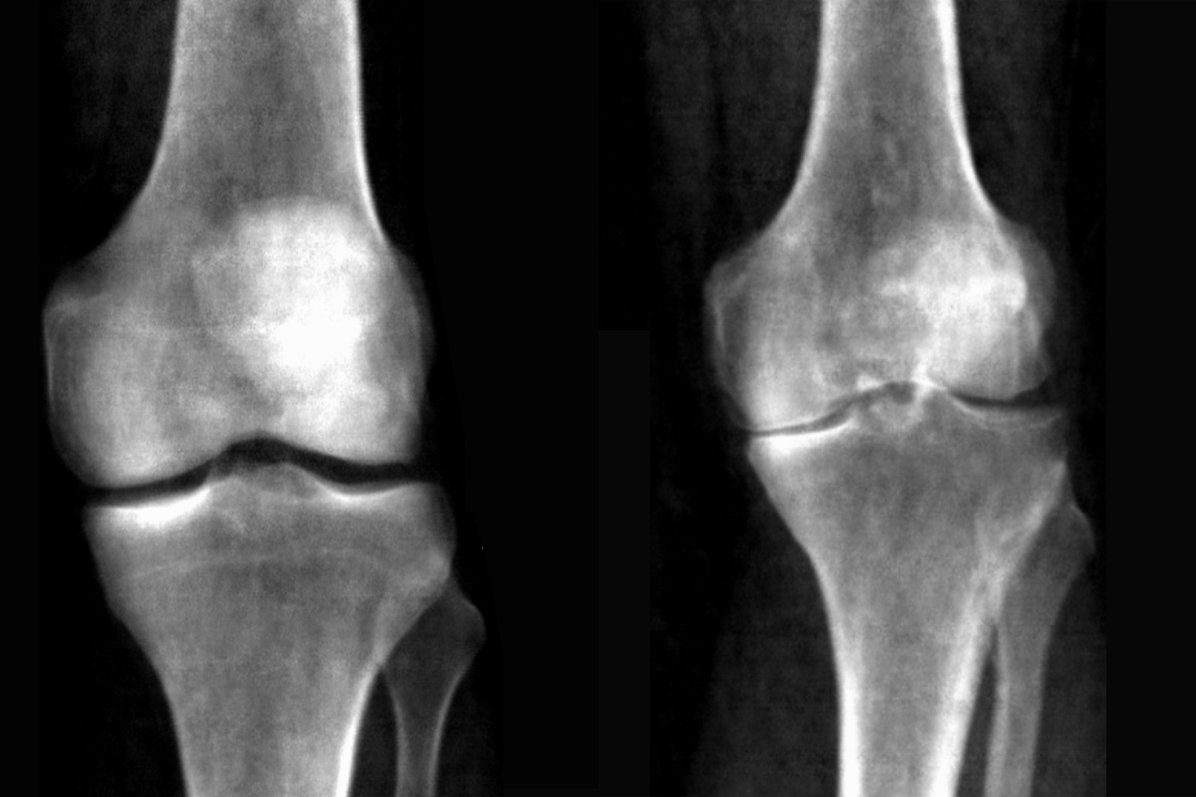 Two x-rays of knees