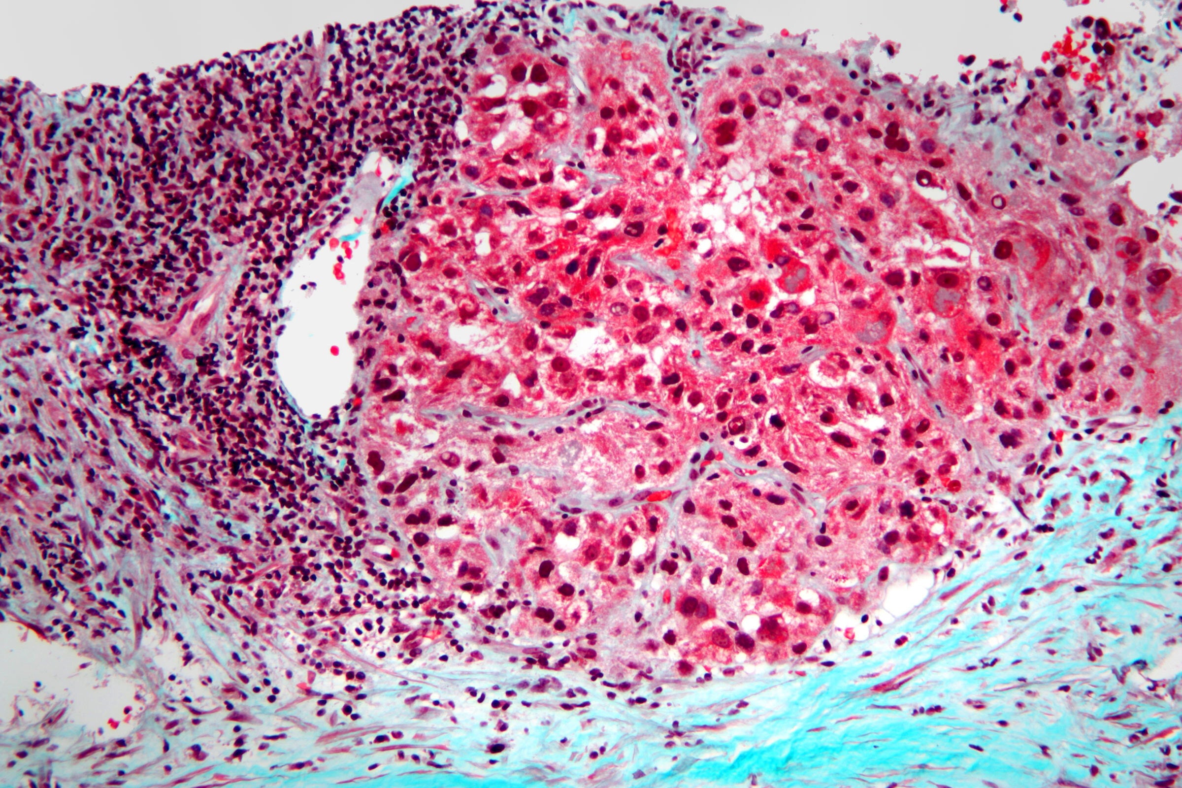 Microscopic cells stained pink and blue, representing melanoma cells