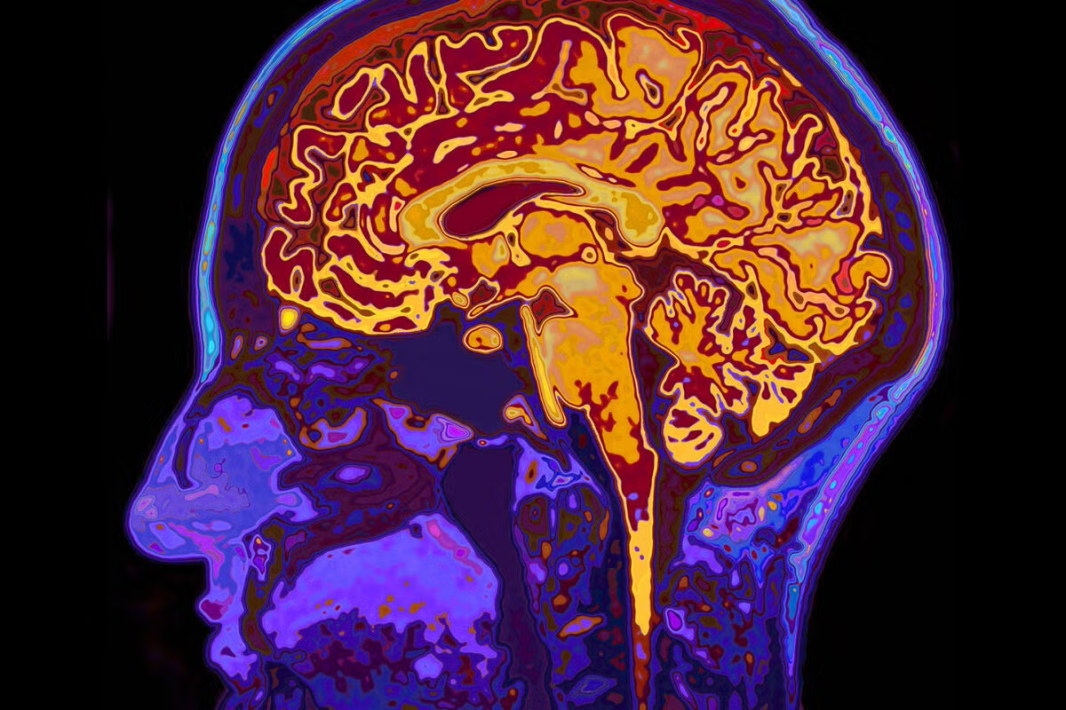 A brain scan with a head in profile shows swirls of red, gold, pink and yellow in the brain and brain stem areas.